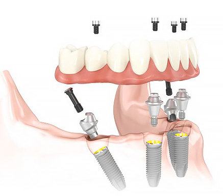 オールオン4の図