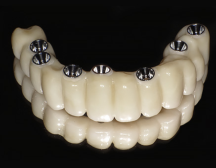 上部構造(かぶせ)