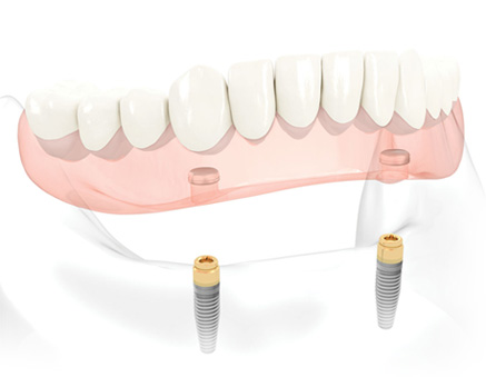 オーバーデンチャーの図