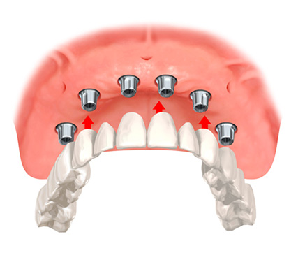 即時負荷インプラントの図